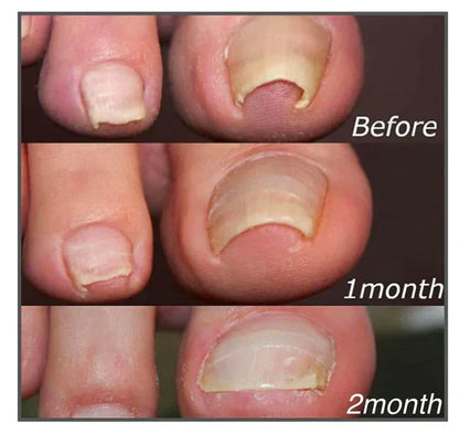 Correction Patches for Beautiful and Healthy Nails